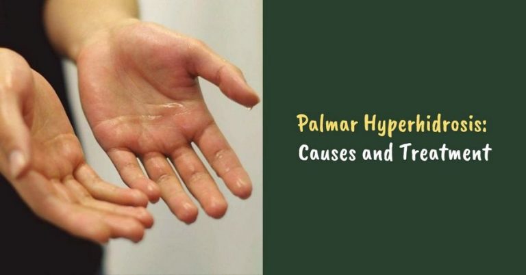 Palmar-Hyperhidrosis – Hyperhidrosis Info – Excessive Sweating of Face ...